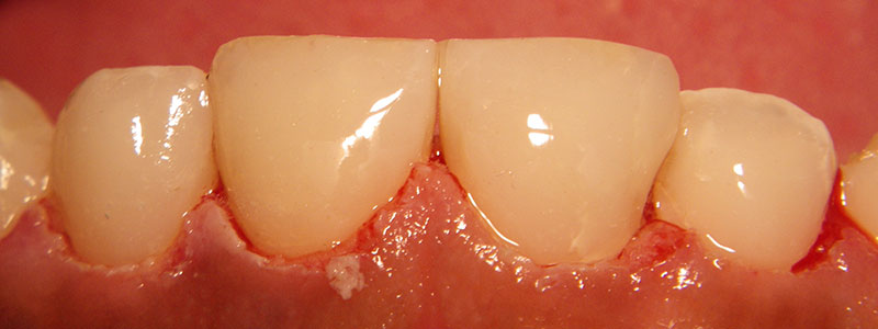 Before and After Patient Photo - Dr. Stephen J. Krawiec, DDS, PC