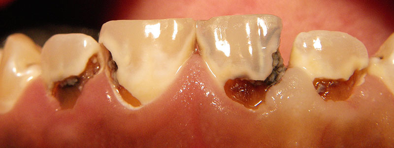 Before and After Patient Photo - Dr. Stephen J. Krawiec, DDS, PC