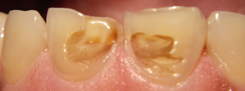Before and After Patient Photo - Dr. Stephen J. Krawiec, DDS, PC