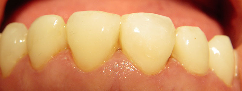 Before and After Patient Photo - Dr. Stephen J. Krawiec, DDS, PC